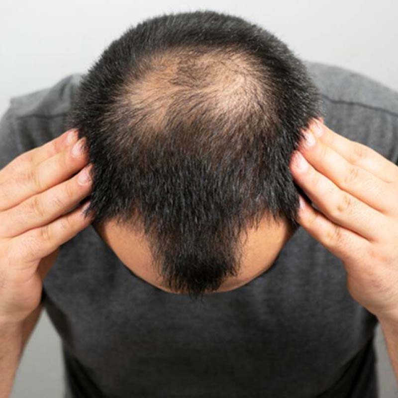 HAIR TRANSPLANT